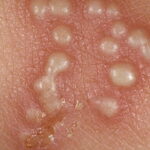 Kenali Gejala Herpes Genitalis Pada Wanita